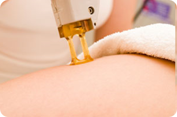 Laser Hair Removal - Alexandrite and Diode